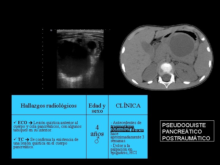 Hallazgos radiológicos ECO Lesión quística anterior al cuerpo y cola pancréaticos, con algunos tabiques