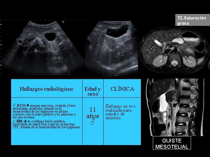 T 2, Saturación grasa Hallazgos radiológicos ECO imagen anecoica, ovalada y bien delimitada, avascular,