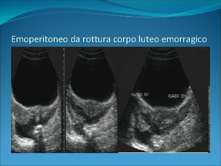 Emoperitoneo da rottura corpo luteo emorragico 