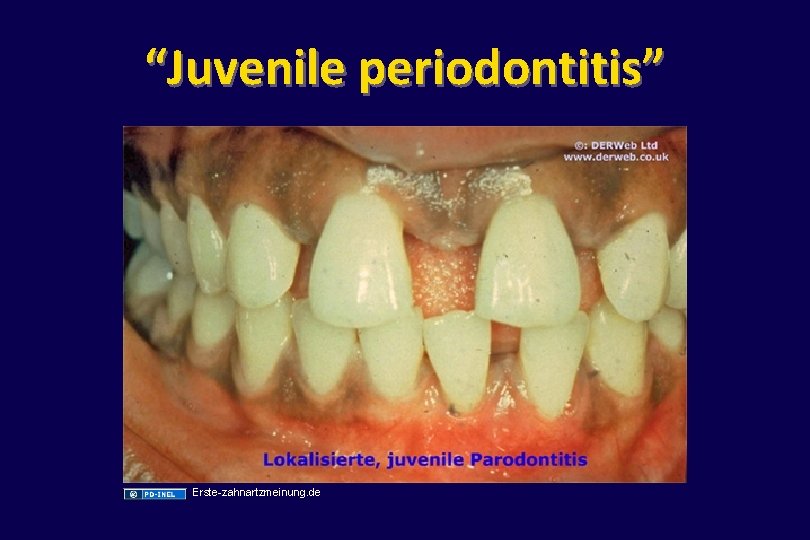 “Juvenile periodontitis” Erste-zahnartzmeinung. de 