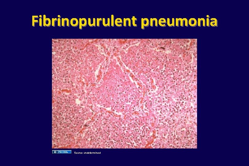 Fibrinopurulent pneumonia Source undetermined 