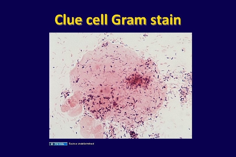 Clue cell Gram stain Source undetermined 