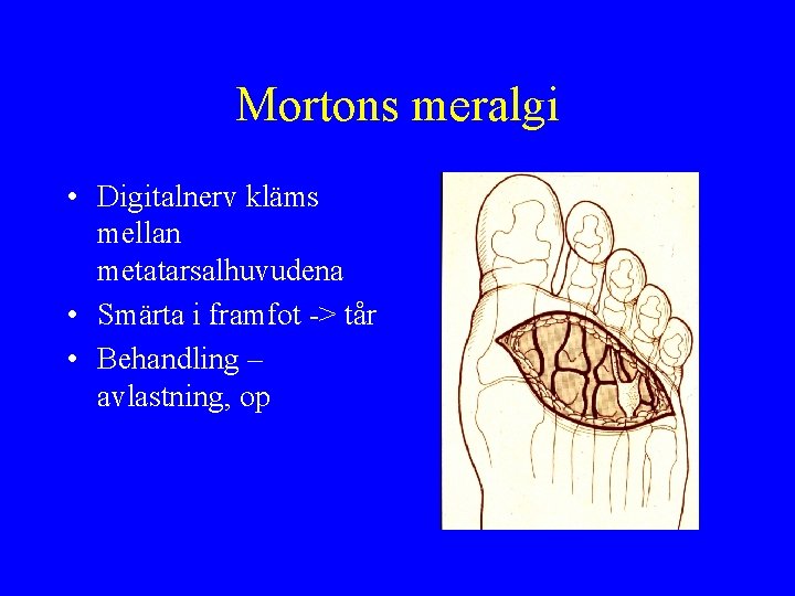 Mortons meralgi • Digitalnerv kläms mellan metatarsalhuvudena • Smärta i framfot -> tår •