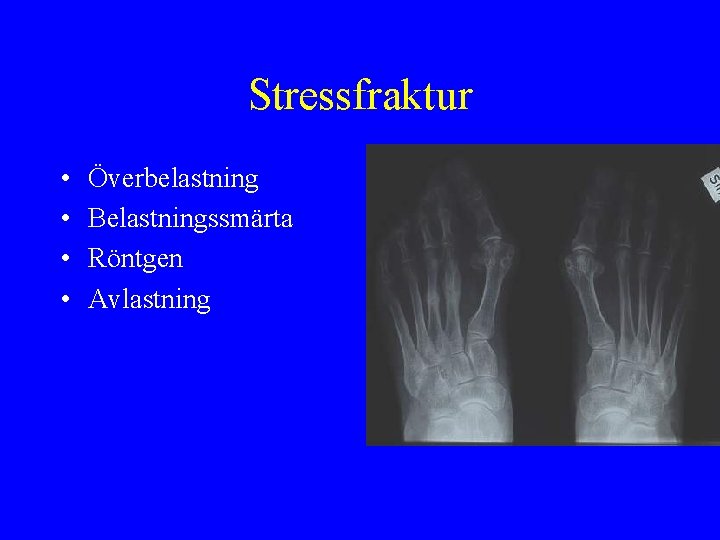 Stressfraktur • • Överbelastning Belastningssmärta Röntgen Avlastning 