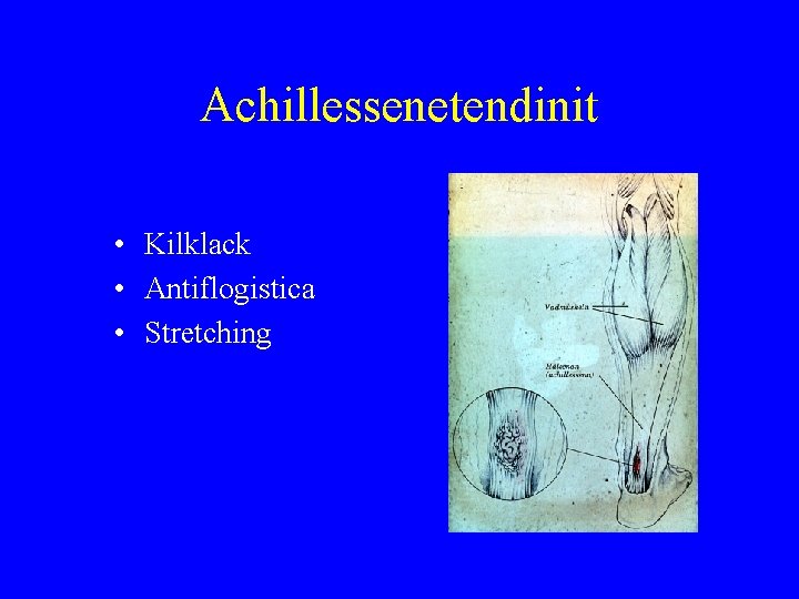 Achillessenetendinit • Kilklack • Antiflogistica • Stretching 