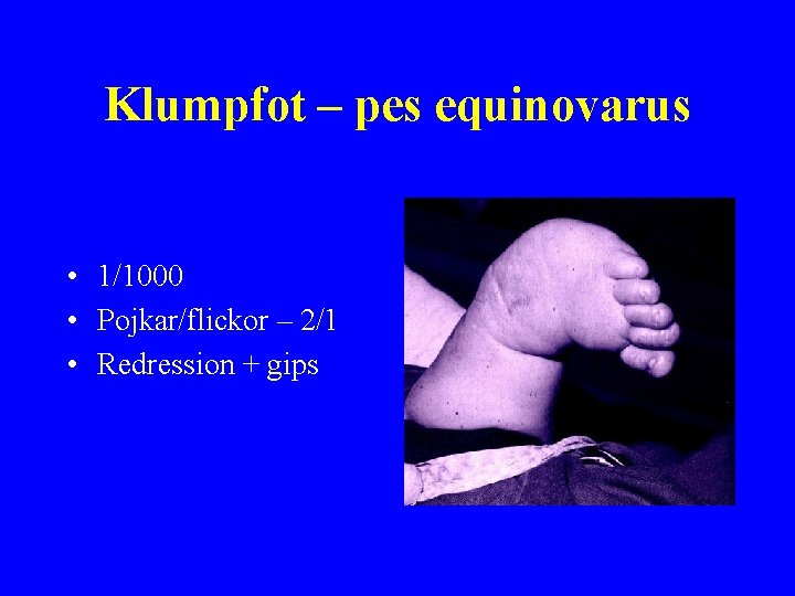 Klumpfot – pes equinovarus • 1/1000 • Pojkar/flickor – 2/1 • Redression + gips