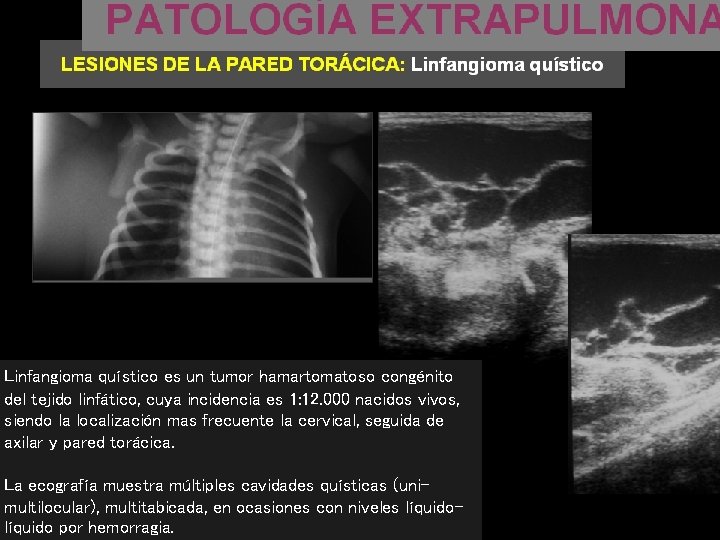 Linfangioma quístico es un tumor hamartomatoso congénito del tejido linfático, cuya incidencia es 1: