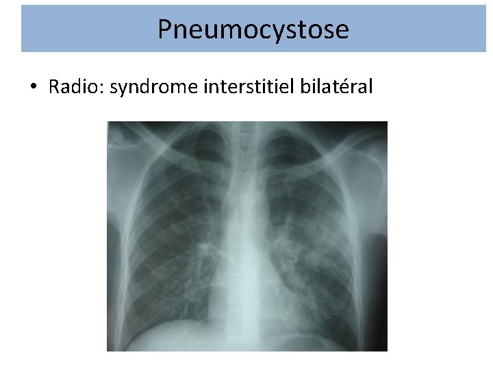 Pneumocystose • Radio: syndrome interstitiel bilatéral 