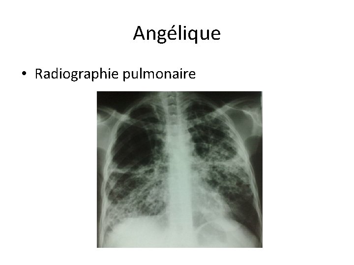 Angélique • Radiographie pulmonaire 