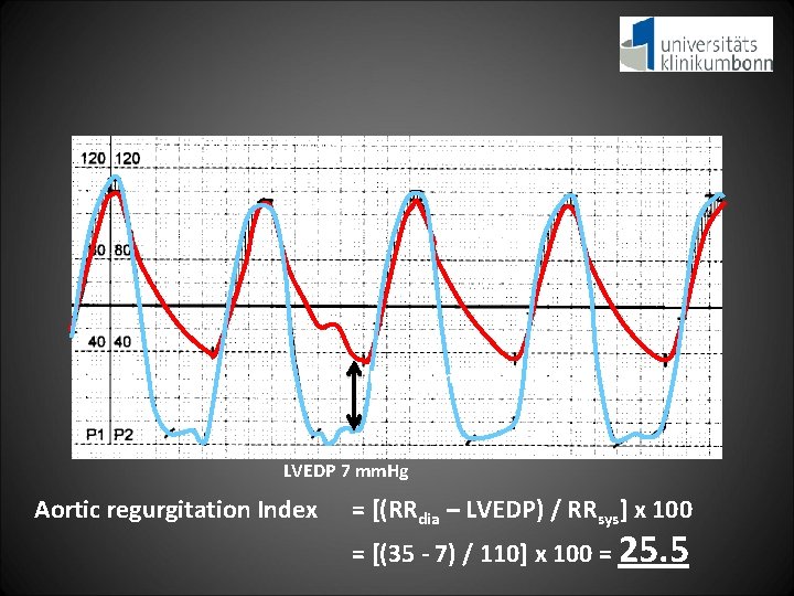 RRsys 110 mm. Hg RRdia 37 mm. Hg LVEDP 7 mm. Hg Aortic regurgitation