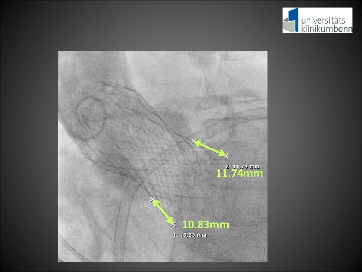 11. 74 mm 10. 83 mm 