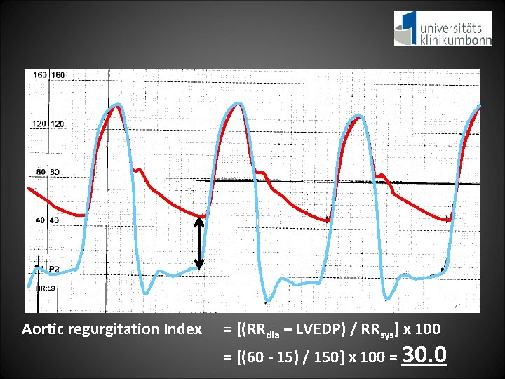 RRsys 150 mm. Hg RRdia 60 mm. Hg LVEDP 15 mm. Hg Aortic regurgitation