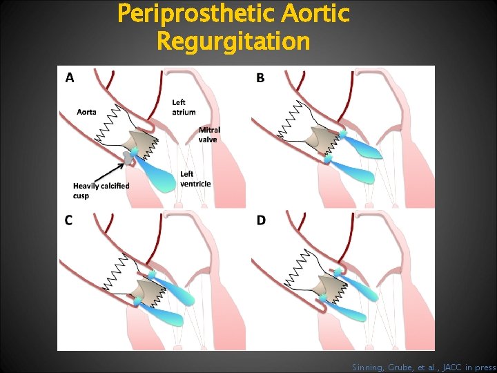 Periprosthetic Aortic Regurgitation Sinning, Grube, et al. , JACC in press 