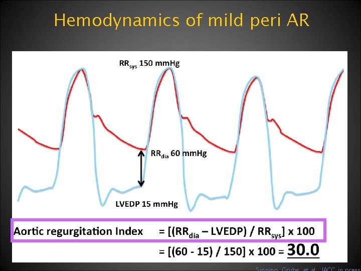 Hemodynamics of mild peri AR 