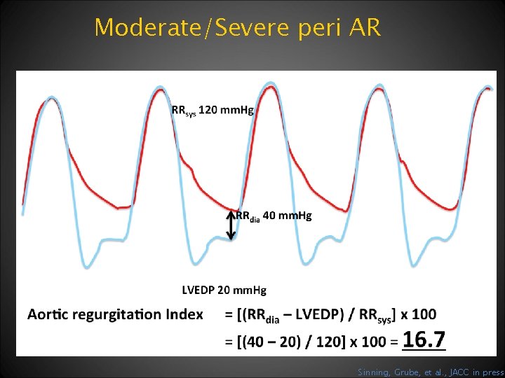 Moderate/Severe peri AR Sinning, Grube, et al. , JACC in press 