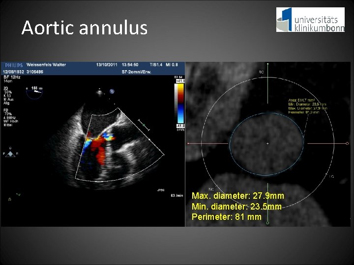 Aortic annulus Max. diameter: 27. 9 mm Min. diameter: 23. 5 mm Perimeter: 81