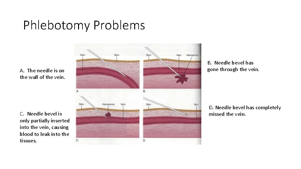 Phlebotomy Problems A. The needle is on the wall of the vein. C. Needle