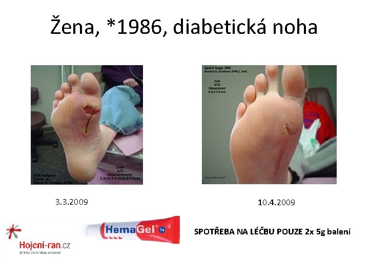 Žena, *1986, diabetická noha 3. 3. 2009 10. 4. 2009 SPOTŘEBA NA LÉČBU POUZE