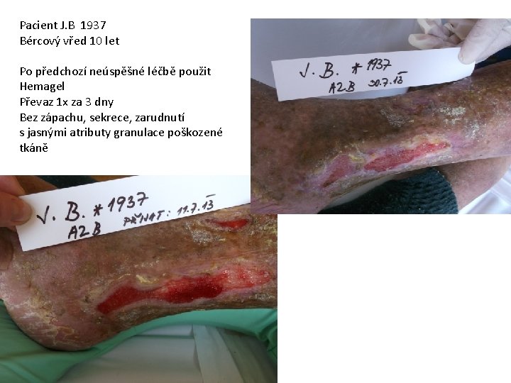 Pacient J. B 1937 Bércový vřed 10 let Po předchozí neúspěšné léčbě použit Hemagel