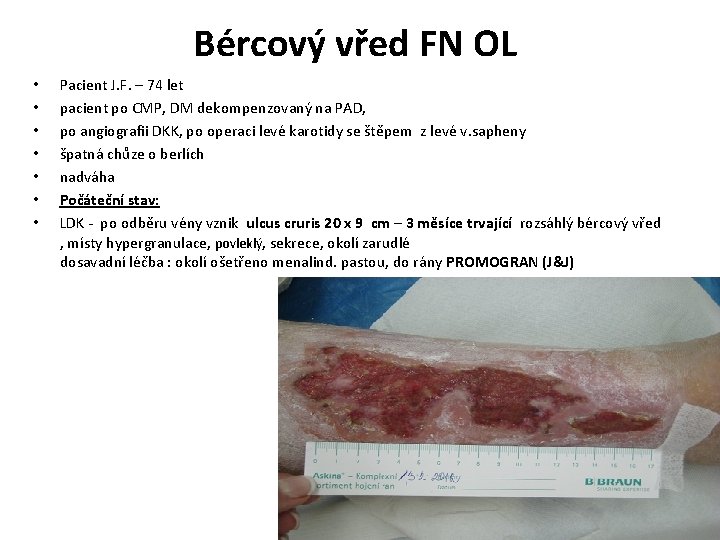 Bércový vřed FN OL • • Pacient J. F. – 74 let pacient po
