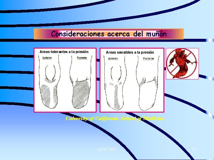 Consideraciones acerca del muñón Areas tolerantes a la presión Areas sensibles a la presión