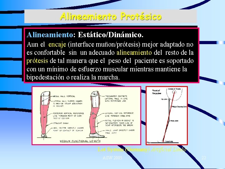 Alineamiento Protésico Alineamiento: Estático/Dinámico. Aun el encaje (interface muñon/prótesis) mejor adaptado no es confortable