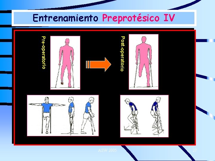 Entrenamiento Preprotésico IV Post-operatorio Pre-operatorio ASW 2005 27 