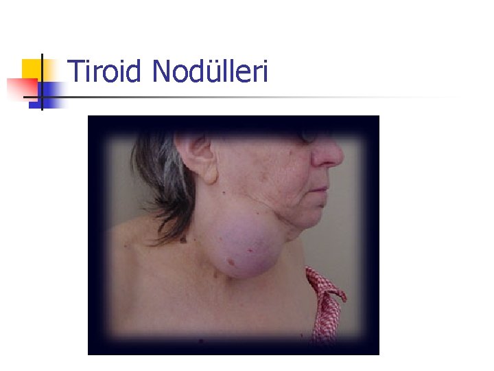 Tiroid Nodülleri 