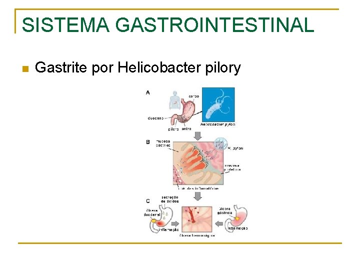 SISTEMA GASTROINTESTINAL n Gastrite por Helicobacter pilory 
