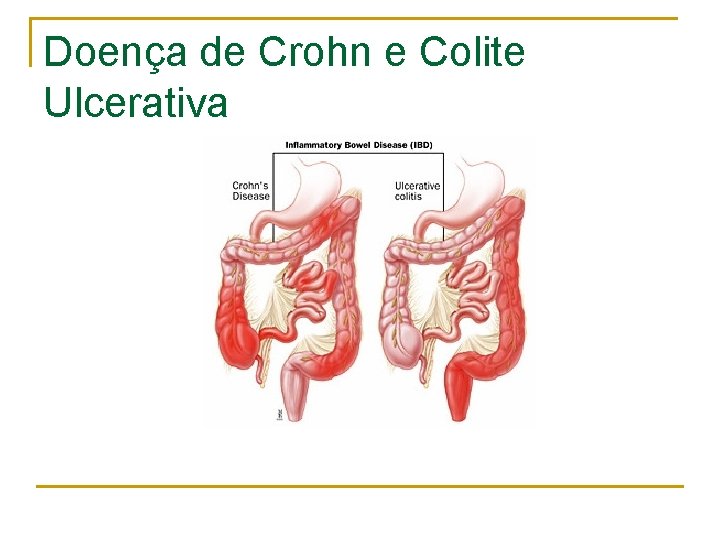 Doença de Crohn e Colite Ulcerativa 