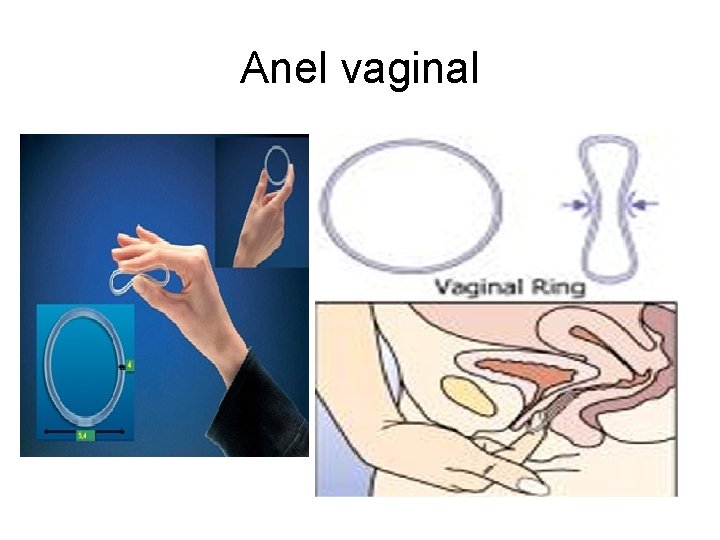 Anel vaginal 
