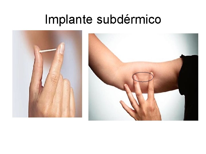 Implante subdérmico 