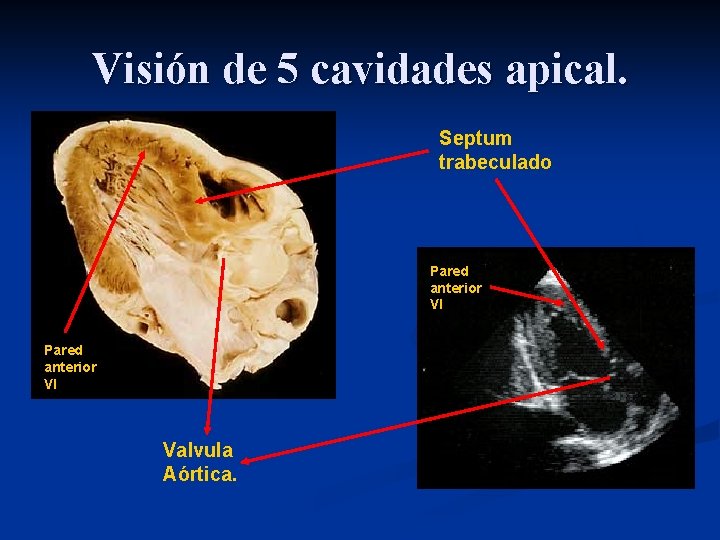Visión de 5 cavidades apical. Septum trabeculado Pared anterior VI Valvula Aórtica. 