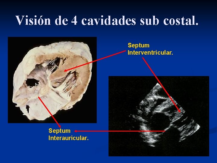 Visión de 4 cavidades sub costal. Septum Interventricular. Septum Interauricular. 