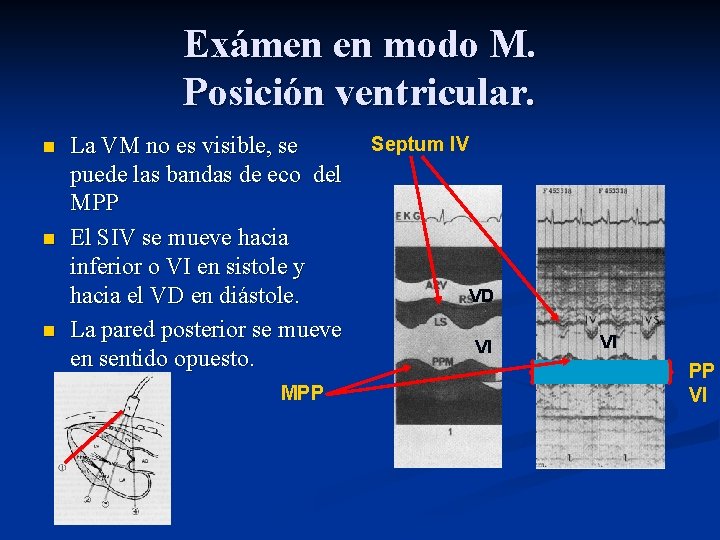 Exámen en modo M. Posición ventricular. n n n La VM no es visible,