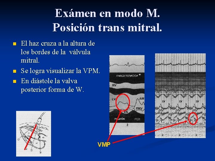 Exámen en modo M. Posición trans mitral. n n n El haz cruza a