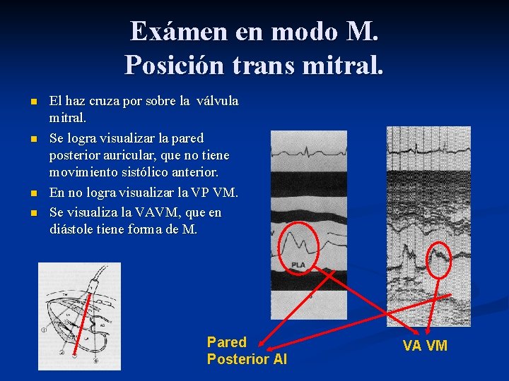 Exámen en modo M. Posición trans mitral. n n El haz cruza por sobre