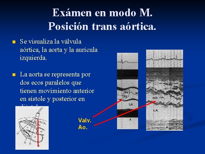 Exámen en modo M. Posición trans aórtica. n Se visualiza la válvula aórtica, la