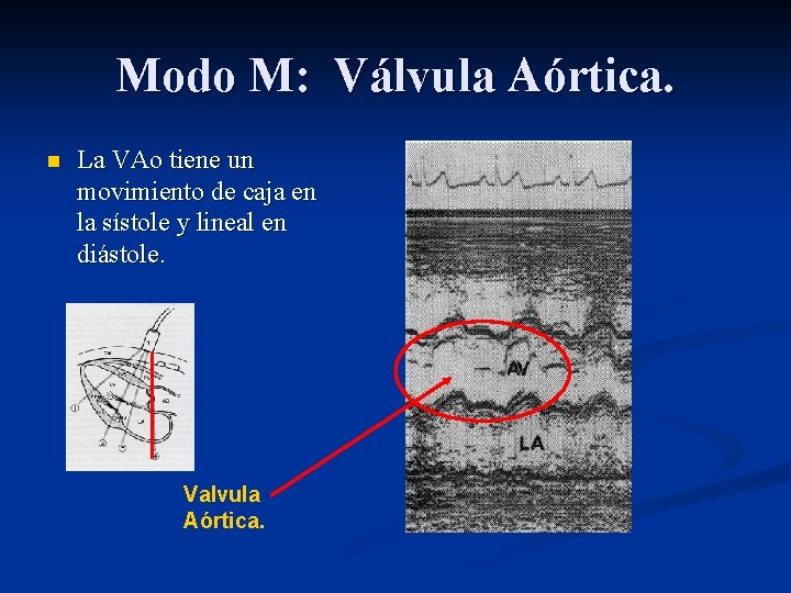 Modo M: Válvula Aórtica. n La VAo tiene un movimiento de caja en la