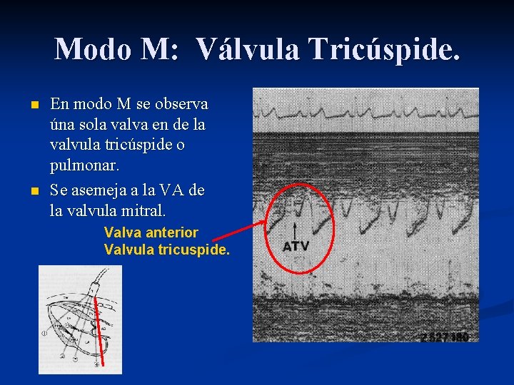 Modo M: Válvula Tricúspide. n n En modo M se observa úna sola valva