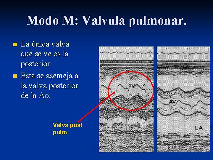 Modo M: Valvula pulmonar. n n La única valva que se ve es la