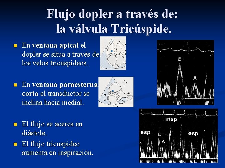 Flujo dopler a través de: la válvula Tricúspide. n En ventana apical el dopler