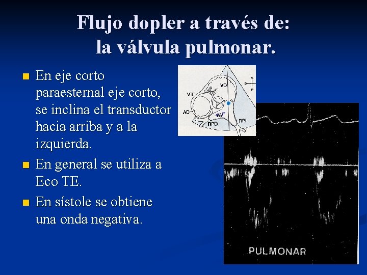 Flujo dopler a través de: la válvula pulmonar. n n n En eje corto