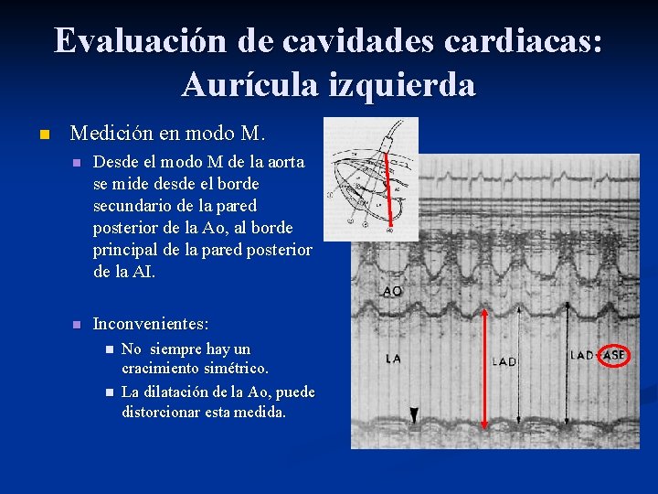 Evaluación de cavidades cardiacas: Aurícula izquierda n Medición en modo M. n Desde el