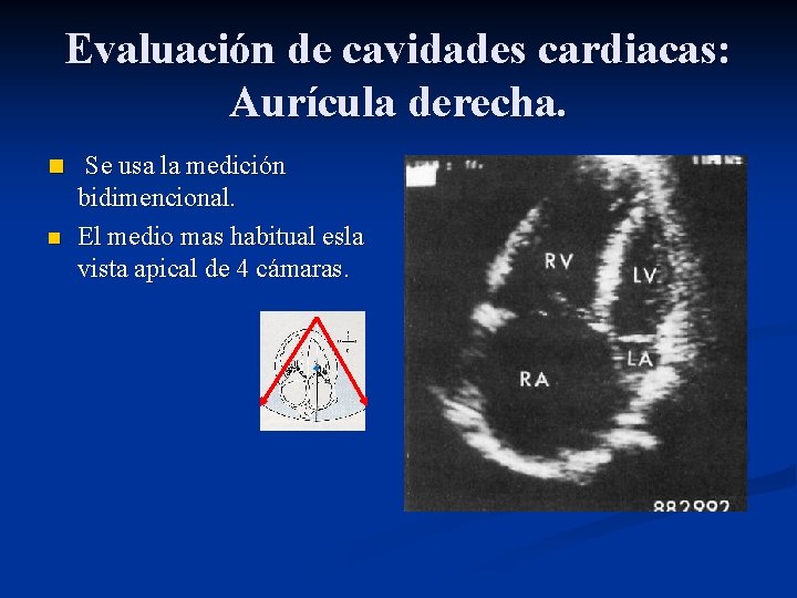Evaluación de cavidades cardiacas: Aurícula derecha. n Se usa la medición n bidimencional. El