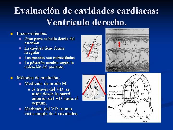 Evaluación de cavidades cardiacas: Ventrículo derecho. n Inconvenientes: n n n Gran parte se