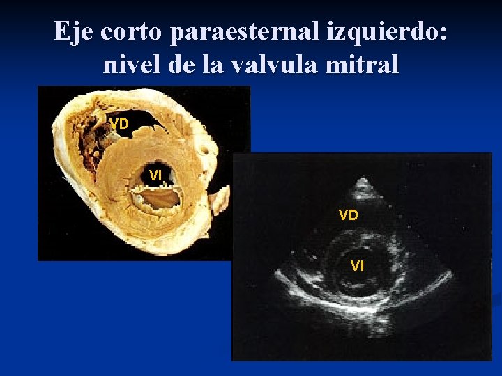 Eje corto paraesternal izquierdo: nivel de la valvula mitral VD VI 