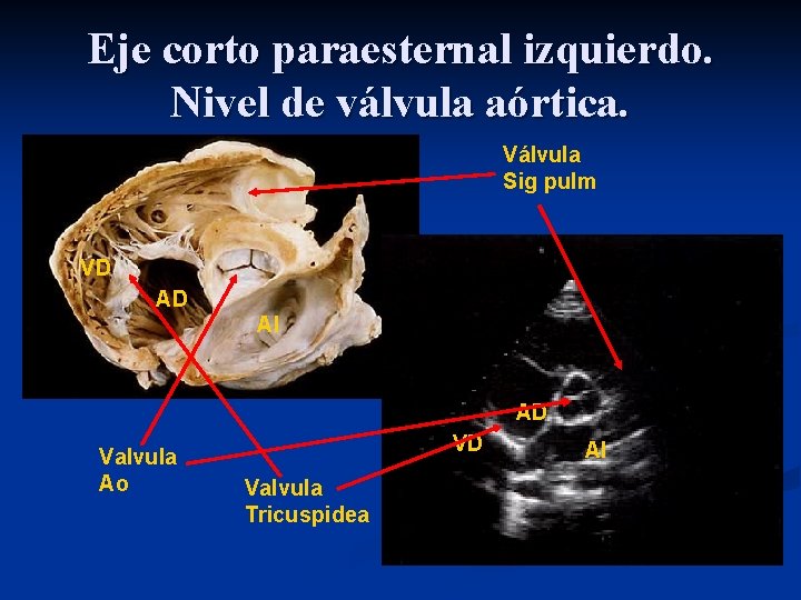 Eje corto paraesternal izquierdo. Nivel de válvula aórtica. Válvula Sig pulm VD AD AI