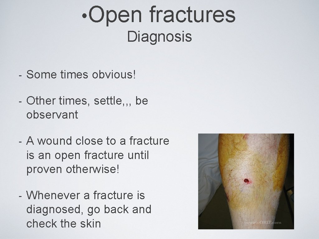  • Open fractures Diagnosis - Some times obvious! - Other times, settle, ,