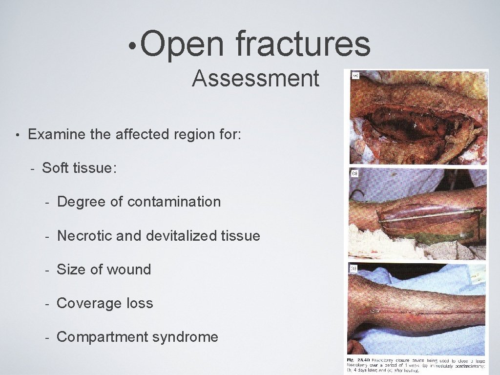  • Open fractures Assessment • Examine the affected region for: - Soft tissue: